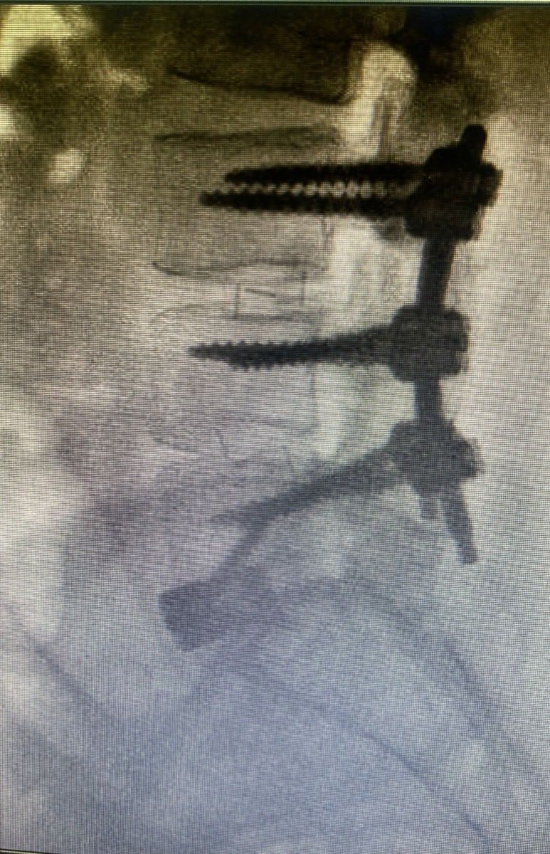 Radiografía posoperatoria con instrumentación lumbar