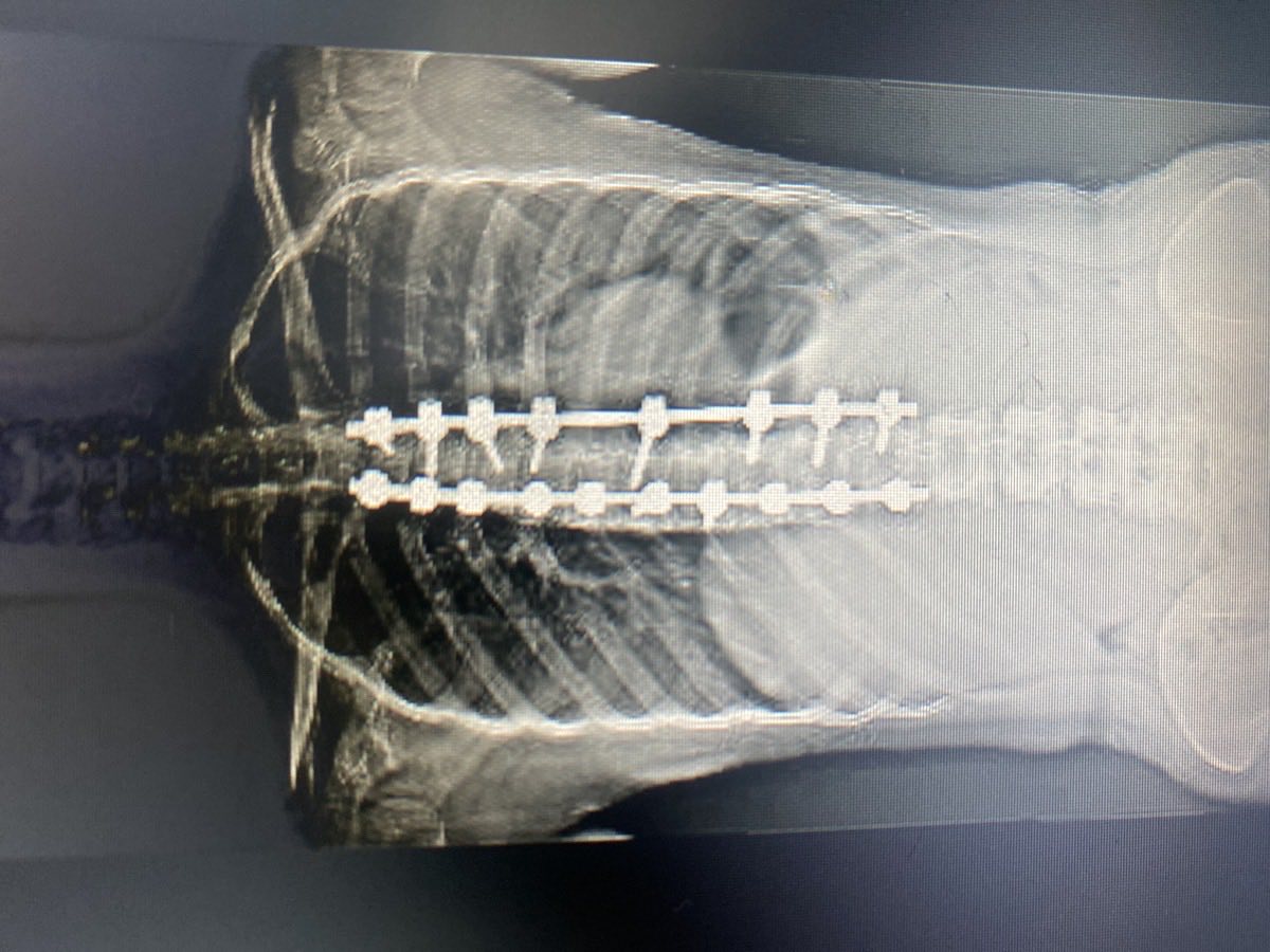 Radiografía posterior: columna corregida y estabilizada