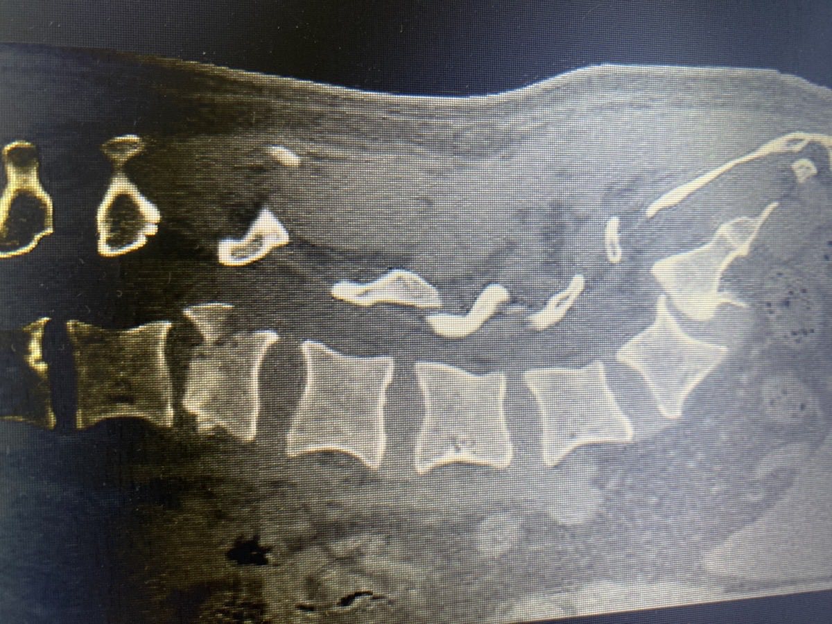 Tomografía previa: fractura vertebral