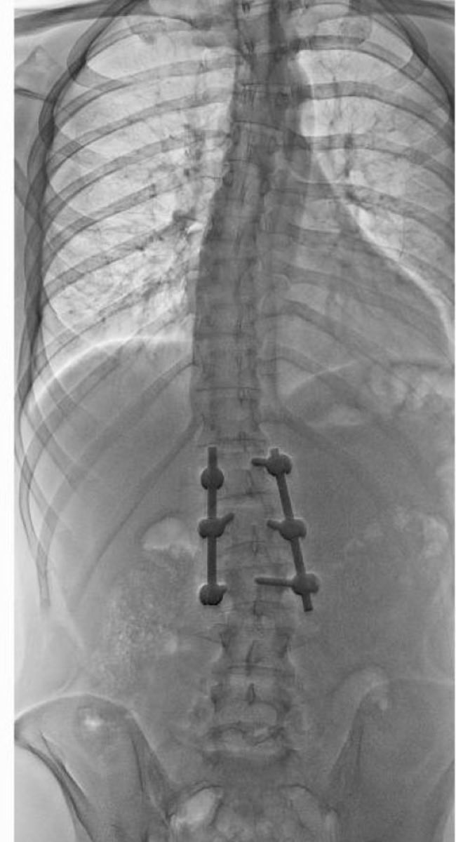 Radiografía posterior: fractura estabilizada con tornillos