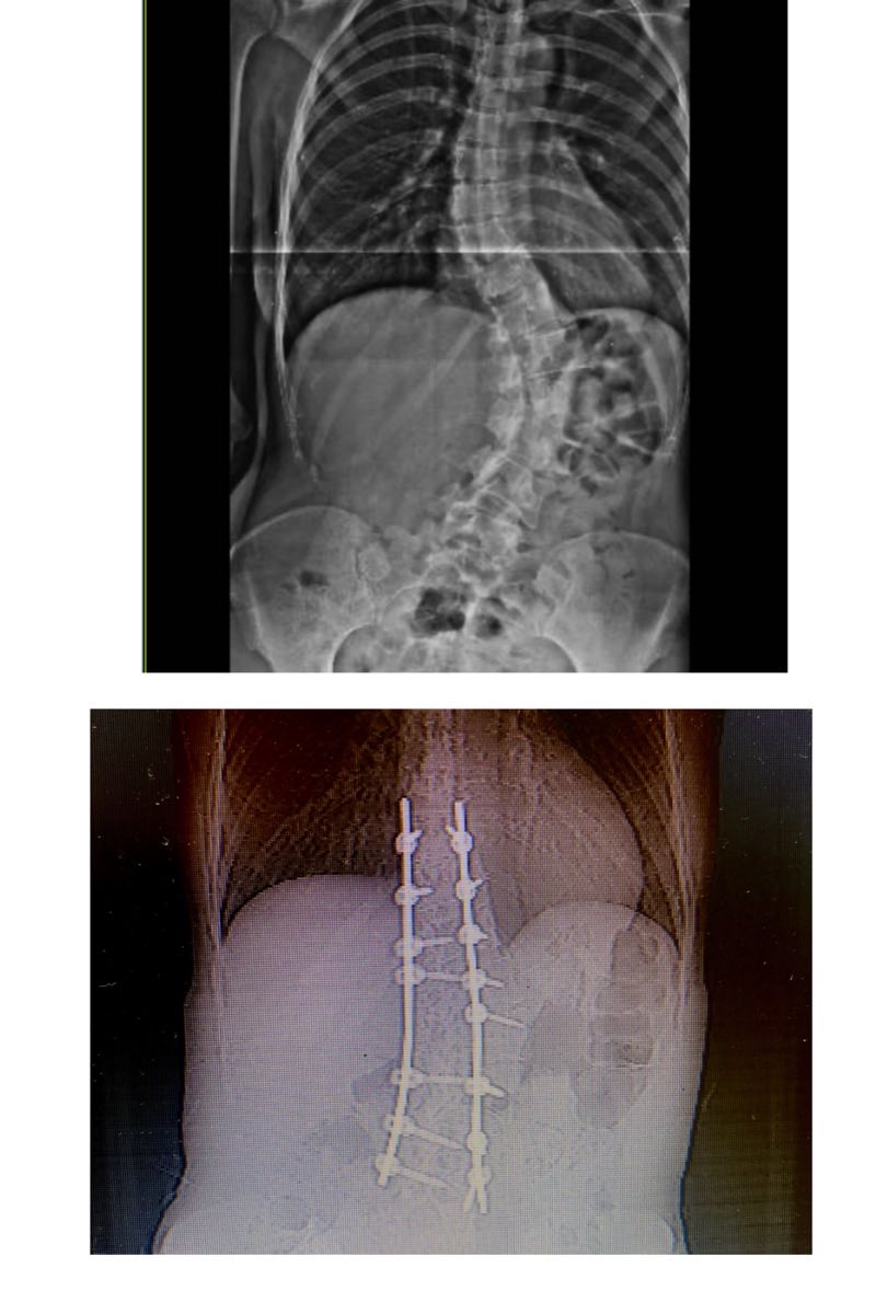 Radiografía antes y después de la cirugía de escoliosis